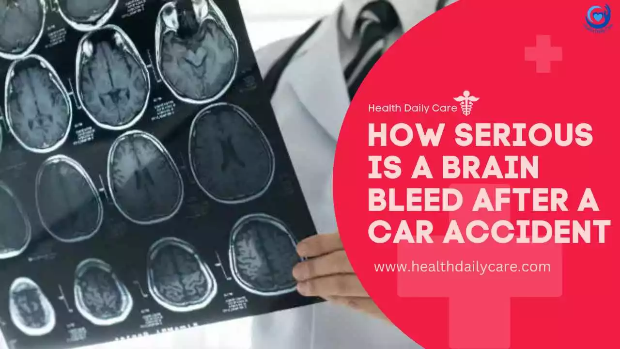 how-serious-is-a-brain-bleed-after-a-car-accident