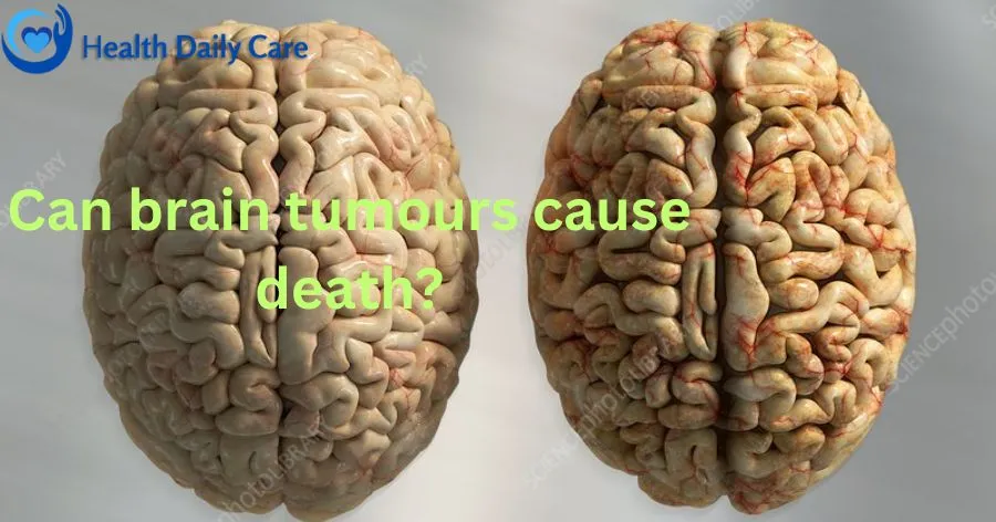 Can brain tumours cause death